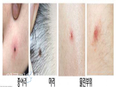 참진드기 주요 흡혈 부위  ⓒ위클리서울/경북도